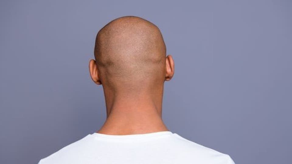 چرا مردان طاس بیشتر در معرض ویروس کرونا قرار مى‌گیرند؟